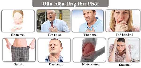 Dấu hiệu nhận biết sớm ung thư phổi - Bệnh viện Bãi Cháy